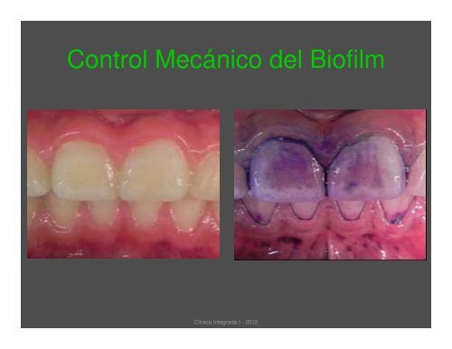 Control Mecánico de Biofilm Dental Registro y Evaluación