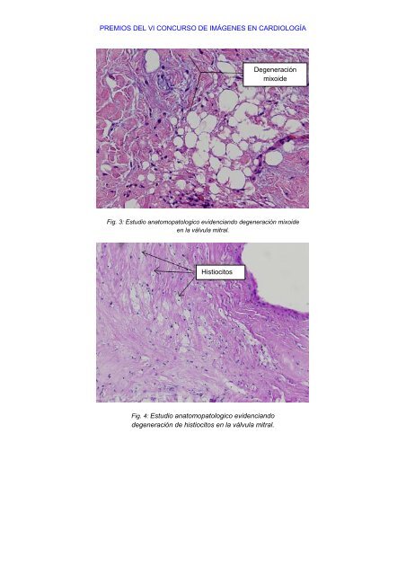 ENDOCARDITIS MITROAÓRTICA