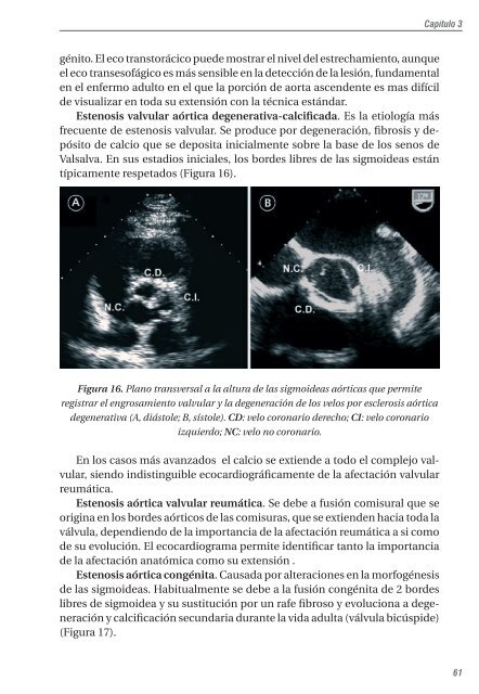 capítulo 3. el ecocardiograma en las valvulopatías - Asociación ...