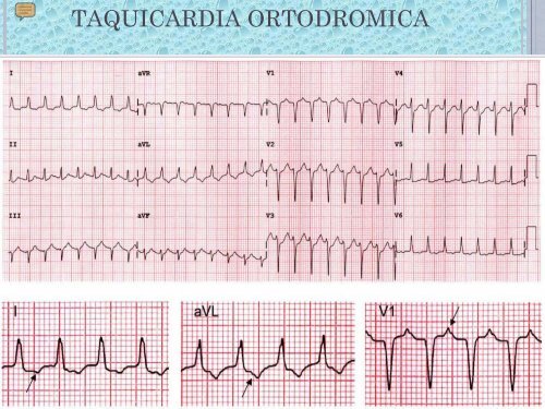 Taquicardia Supraventricular - Osakidetza