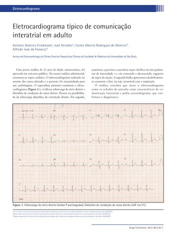 Eletrocardiograma típico de comunicação interatrial em adulto