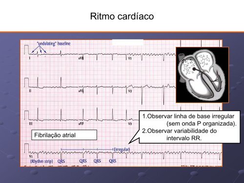 Noções Básicas De Eletrocardiograma - EMV-FMB - Unesp