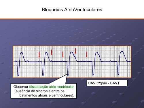 Noções Básicas De Eletrocardiograma - EMV-FMB - Unesp