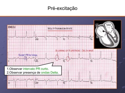 Noções Básicas De Eletrocardiograma - EMV-FMB - Unesp