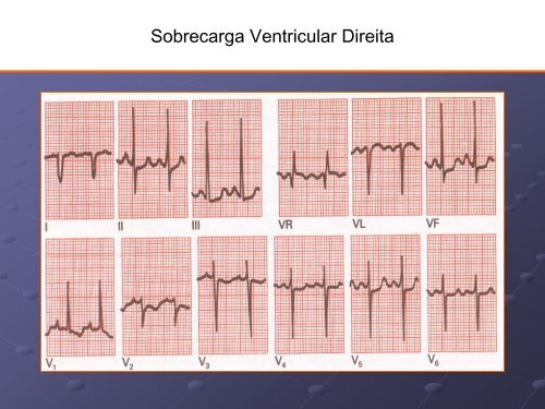 Noções Básicas De Eletrocardiograma - EMV-FMB - Unesp