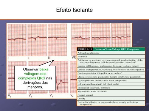 Noções Básicas De Eletrocardiograma - EMV-FMB - Unesp