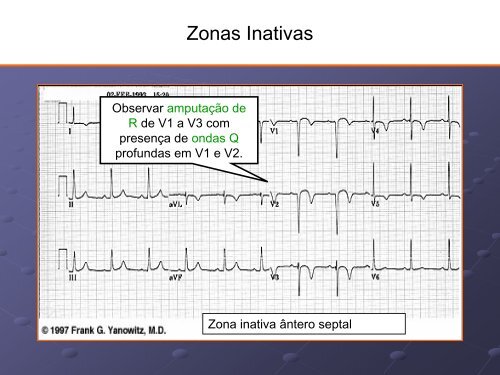 Noções Básicas De Eletrocardiograma - EMV-FMB - Unesp