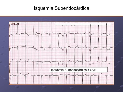 Noções Básicas De Eletrocardiograma - EMV-FMB - Unesp