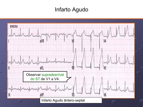 Noções Básicas De Eletrocardiograma - EMV-FMB - Unesp