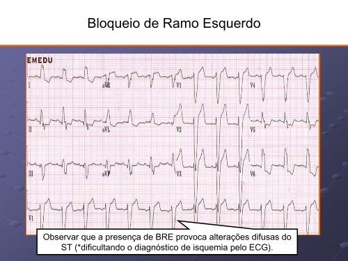 Noções Básicas De Eletrocardiograma - EMV-FMB - Unesp