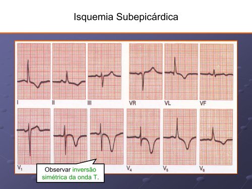 Noções Básicas De Eletrocardiograma - EMV-FMB - Unesp