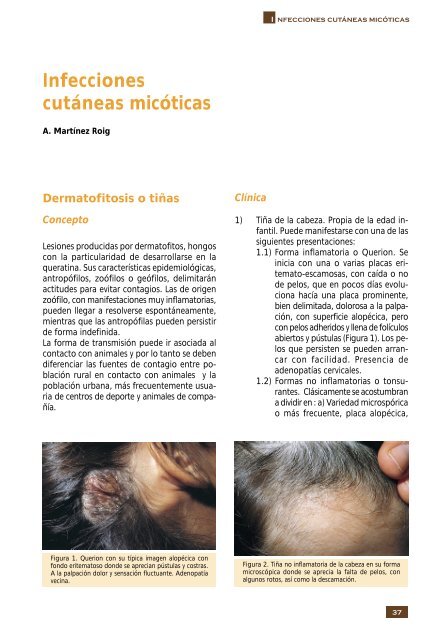 Micosis cutáneas - Asociación Española de Pediatría