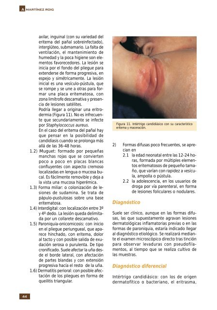 Micosis cutáneas - Asociación Española de Pediatría