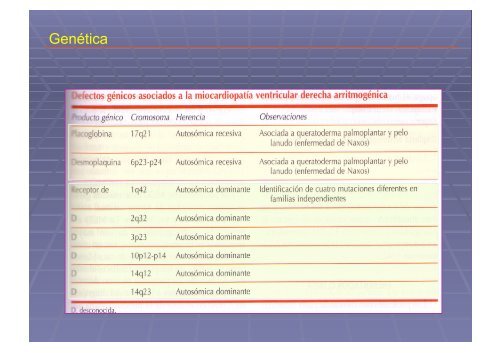 Displasia Arritmogénica del Ventrículo Derecho.