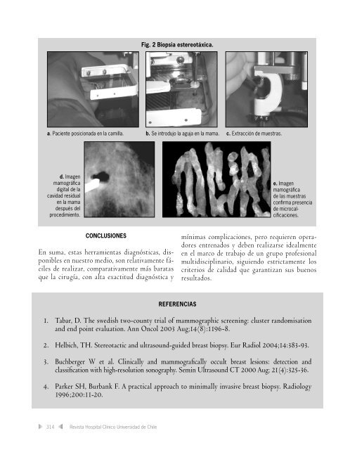 Biopsia Core y Biopsia Estereotáxica Digital - Hospital Clínico ...