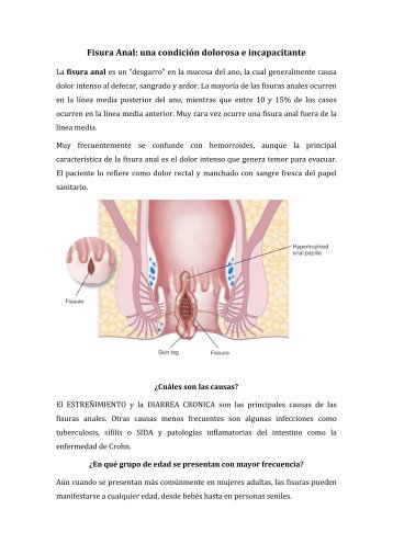 Fisura Anal: una condición dolorosa e ... - Dr. Cesar Galvez