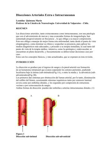 DISECCIONES ARTERIALES EXTRA E INTRACRANEANAS