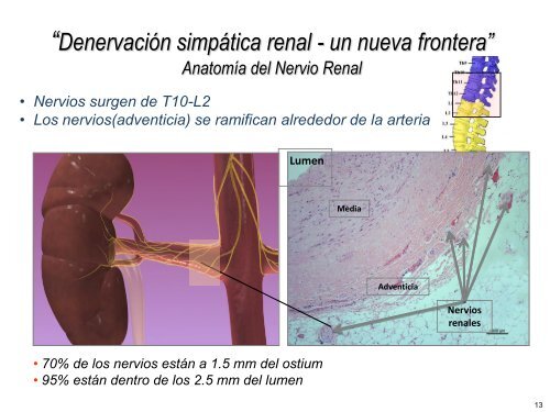 Ablación por radiofrecuencia de arteria renal en la - CACI