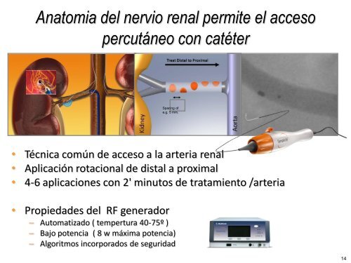 Ablación por radiofrecuencia de arteria renal en la - CACI