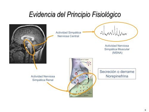 Ablación por radiofrecuencia de arteria renal en la - CACI