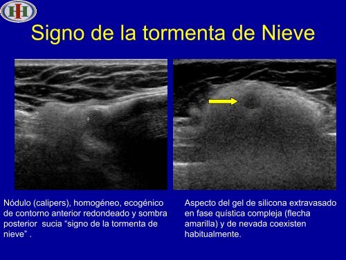 Signo Tormenta de Nieve - Congreso SORDIC