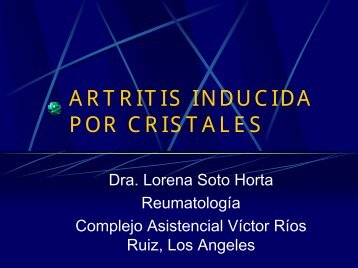 ARTRITIS INDUCIDA POR CRISTALES