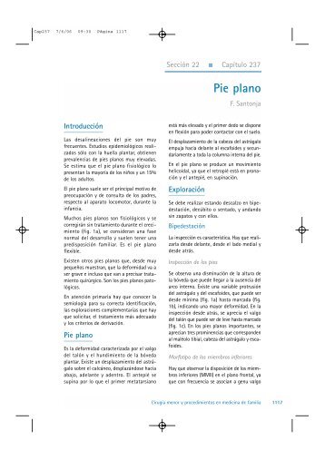 Pie plano (Cap 237) - OCW