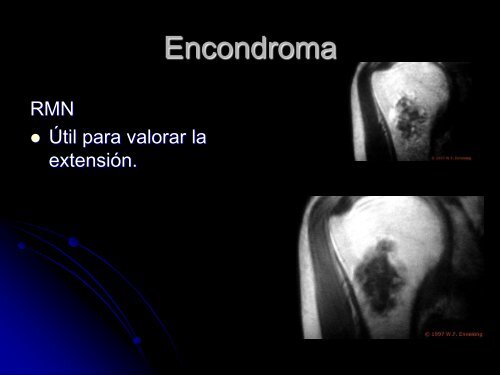 LESIONES CARTILAGINOSAS BENIGNAS