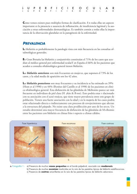 superficie ocular BLEFARITIS - Laboratorios Thea