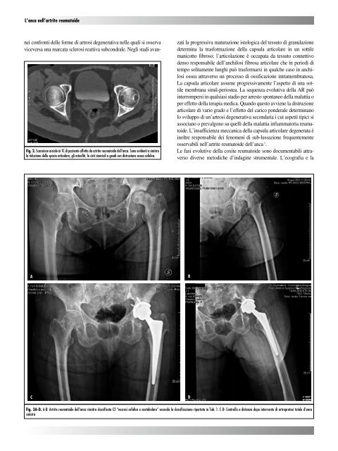 30845 Suppl Giot.pdf - Giornale Italiano di Ortopedia e Traumatologia