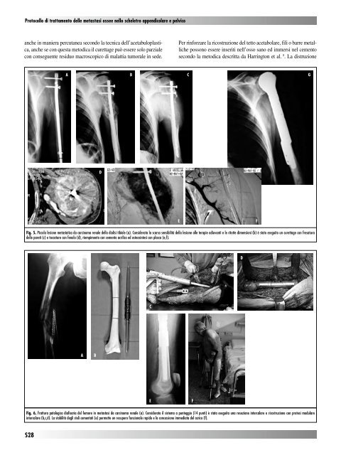 30845 Suppl Giot.pdf - Giornale Italiano di Ortopedia e Traumatologia