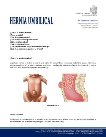 ¿Qué es la hernia umbilical? ¿A qué se debe? ¿Qué síntomas ...