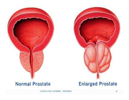 Prevención del Cáncer de Próstata. Dra. Cecilia Barahona - Inppares