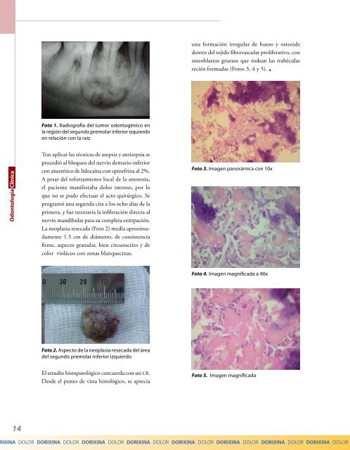 Cementoblastoma: reporte de un caso clínico - IntraMed