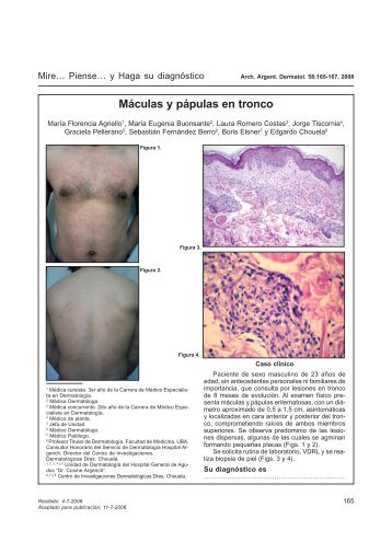 Máculas y pápulas en tronco - Archivos Argentinos de Dermatología