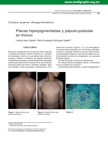 Placas hiperpigmentadas y pápulo-pústulas en tronco