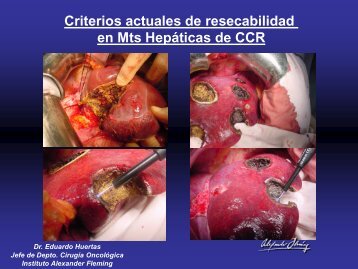 Criterios actuales de resecabilidad en Mts Hepáticas de CCR