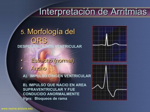 Arritmias Letales