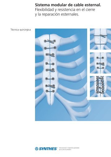 Sistema modular de cable esternal Técnica quirúrgica - Synthes