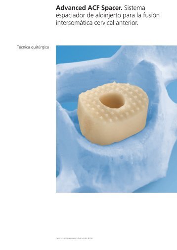 Advanced ACF Spacer Técnica quirúrgica - Synthes