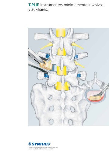 T-PLIF. Instrumentos mínimamente invasivos y auxiliares. - Synthes