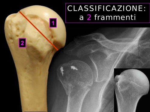 Formato PDF (12 MB) - La spalla