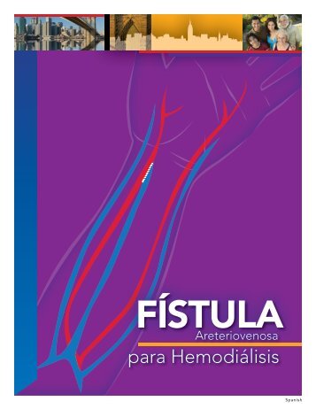 Fístula arteriovenosa - Life Options