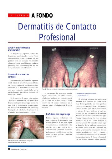 Dermatitis de Contacto Profesional