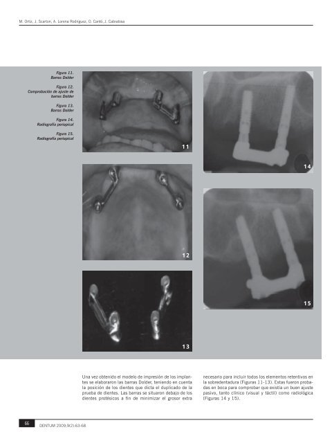 Artículo Sobredentaduras.indd - Nexus Médica