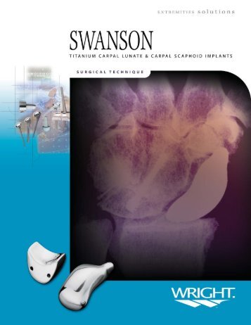 Swanson Carpal Lunate scaphoid 2 ST