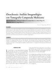 Otosclerosis - Hospital Clínico Universidad de Chile