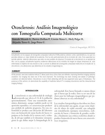 Otosclerosis - Hospital Clínico Universidad de Chile