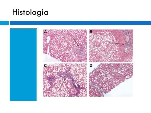 Hígado Graso en el paciente obeso.Dra. Angela M. Farías ... - Aveso