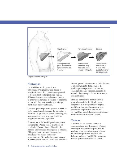 Esteatohepatitis no alcohólica